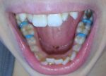 U Ortho Separators - Image 8