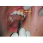 GDC Sickle Scalers Springfield #6 (Ssp2/3) - Image 4