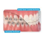 U ortho Niti Tooth Color Wire-Rectangular (Pack of 1) - Image 13