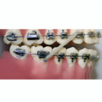 U Ortho Bondable Buccal Tubes - 1st Molar MBT 0.022 - Image 11