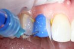 SafeEndo Smart Etch 5ml - Image 5