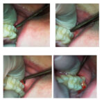 GDC Root Elevators Warwick James Set Of 3 (Ewjs3) - Image 3