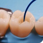 Waldent Plasma+ Composite Instrument Kit of 6 (K14/2) - Image 9