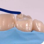 Waldent Plasma+ Composite Instrument Kit of 6 (K14/2) - Image 4