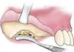 Waldent Oral Surgical Instruments Kit of 10 (K9/1) - Image 6