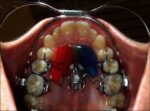 U Ortho Facebow Standard - Image 7