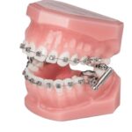 Ormco Advansync 2 Class II Corrector