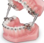 Ormco Advansync 2 Class II Corrector - Image 2