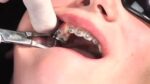 Ormco Advansync 2 Class II Corrector - Image 4